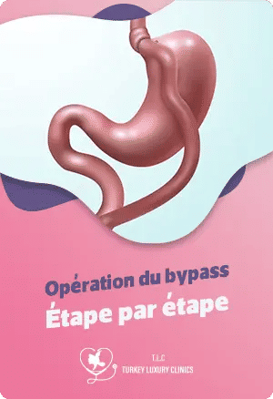 Opération du bypass : Étape par étapefeatured image
