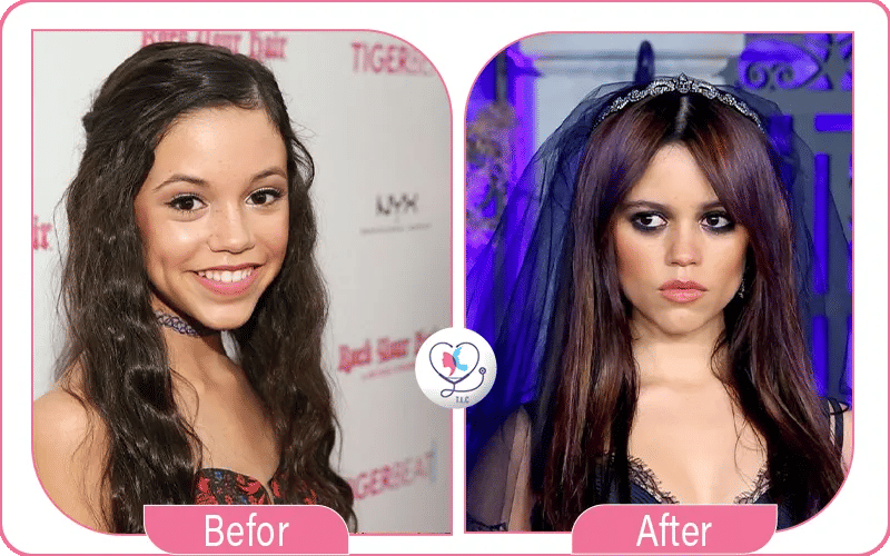 jenna ortega avant apres chirurgie esthétique