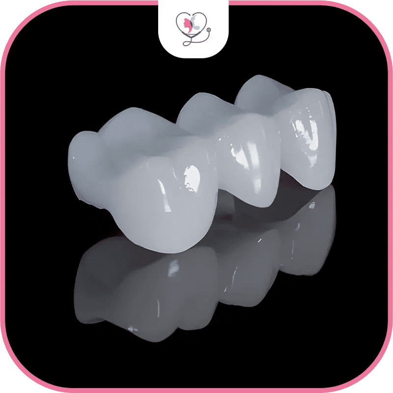 matériaux des bridges dentaires