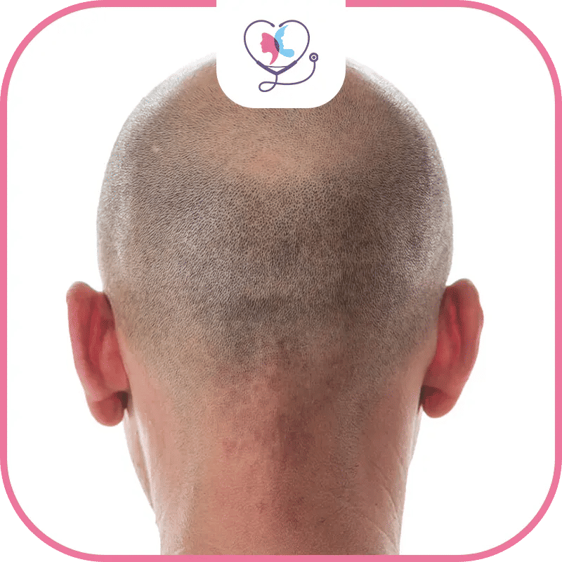المرشحون المثاليون لزراعة الشعر
