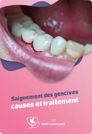 Saignement des gencives : causes et traitementfeatured image