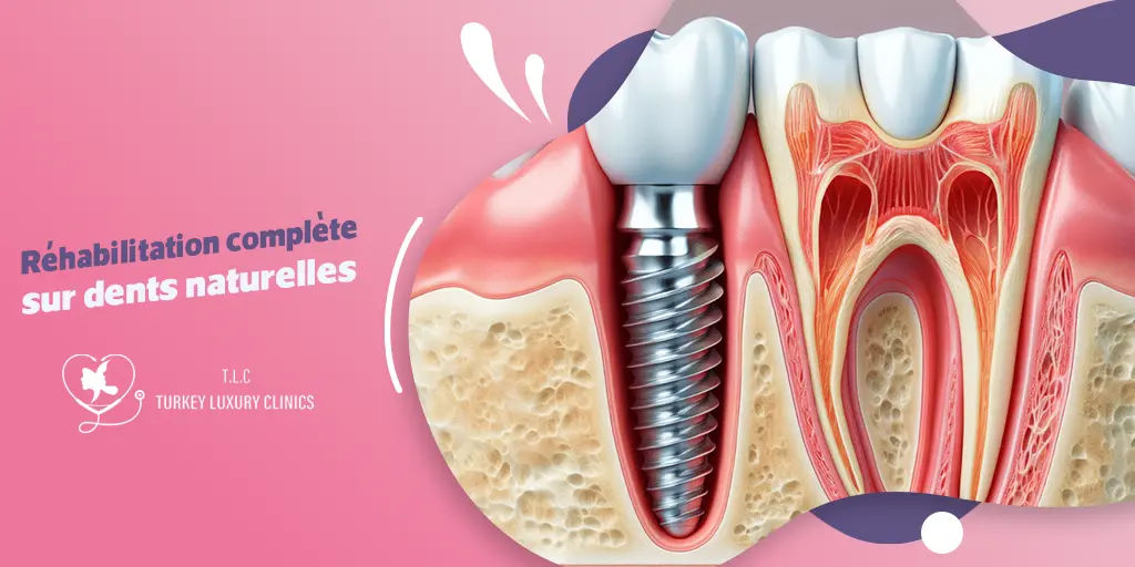 Réhabilitation complète sur dents naturelles : Solutions et Avantages