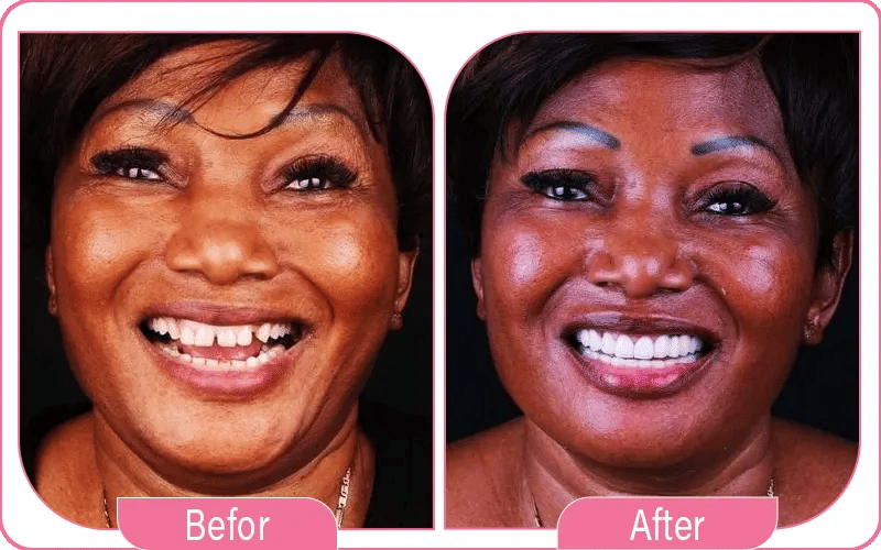 Hollywood Smile Dental Photos Before and After