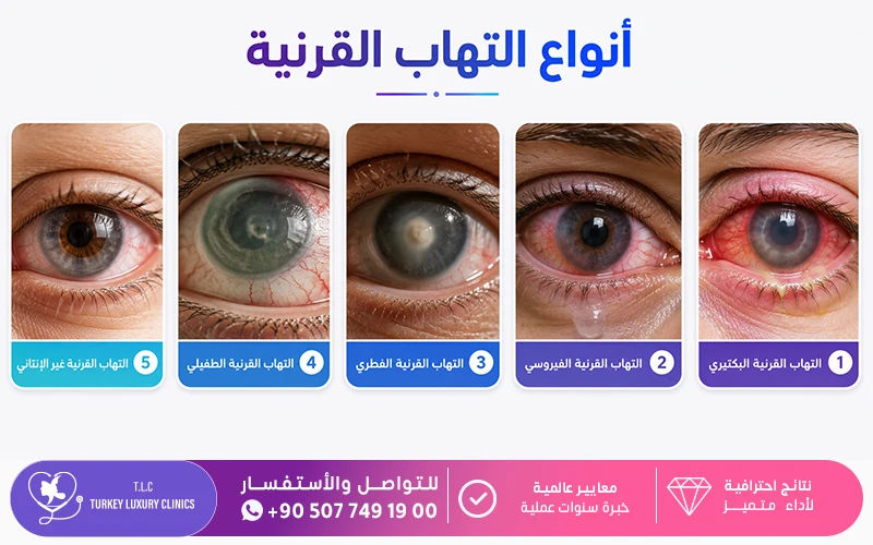 أنواع التهاب القرنية
