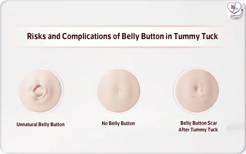 Risks and Complications of Belly Button in Tummy Tuck