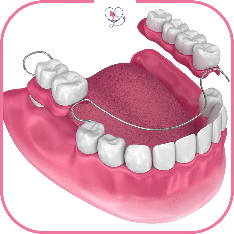 avantages des bridges dentaires