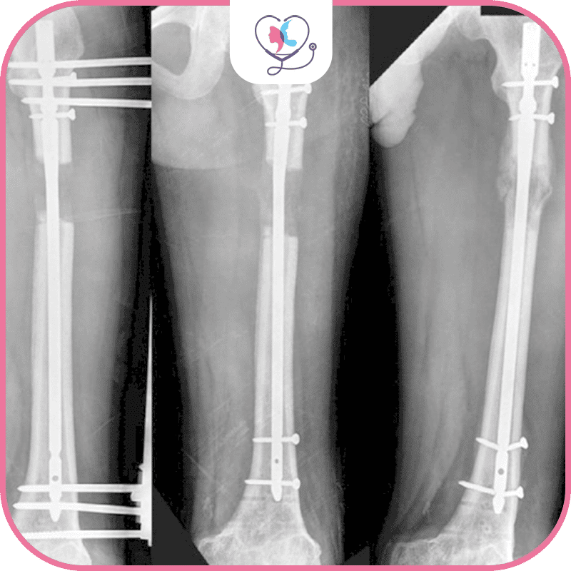 خطوات عملية تطويل القامة بطريقة LON
