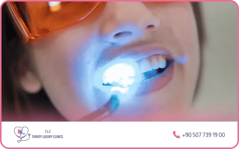 Laser teeth whitening Turkey Istanbul – professional in-clinic whitening treatment at Turkey Luxury Clinics