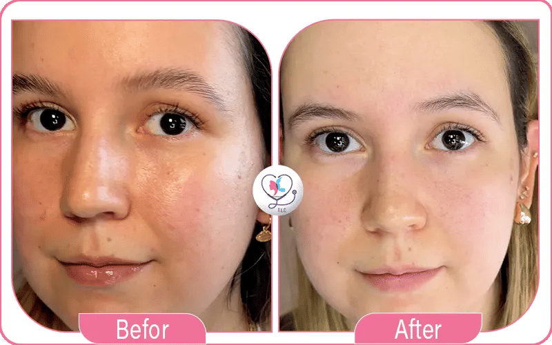 بيبي فيس للوجه قبل وبعد