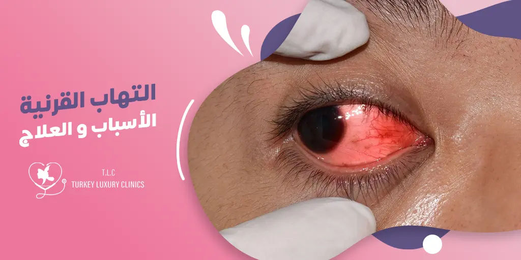 التهاب القرنية: الأسباب، الأعراض والعلاج