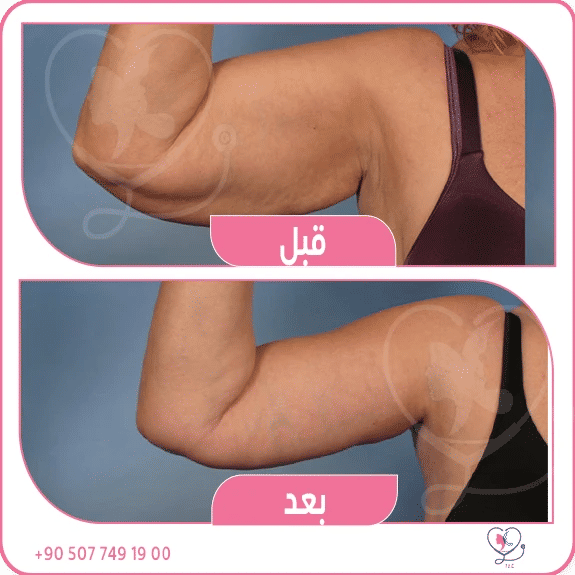 تجربتي في تنحيف الزنود