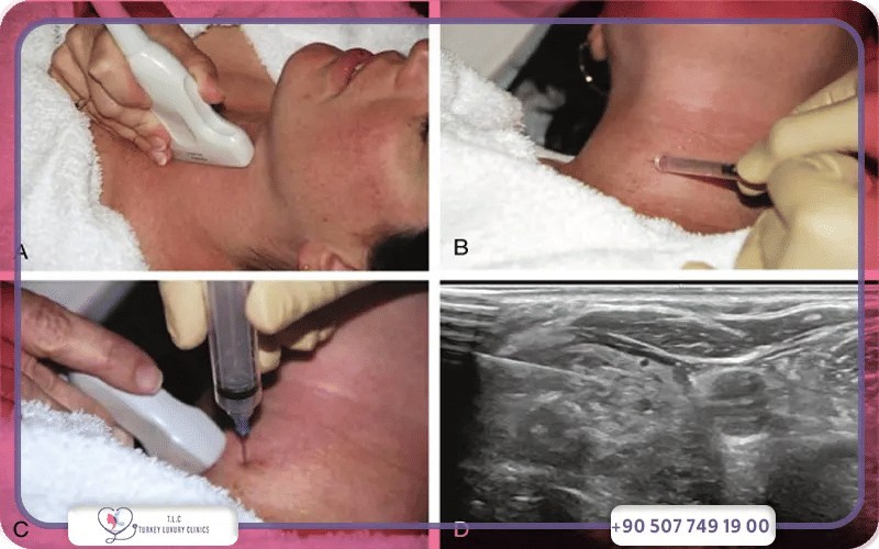كيف يتم أخذ خزعة من الغدة الدرقية في الحالات المعقدة