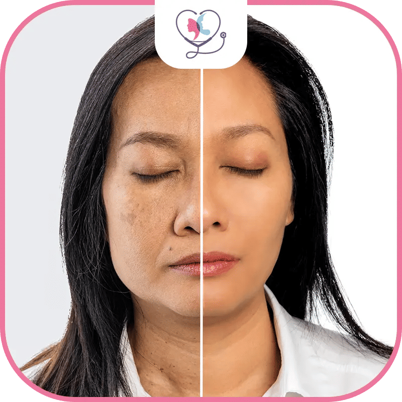 عملية شد الوجه في تركيا