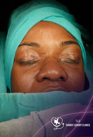 من جربت تصغير فتحات الأنف: الأضرار والأسعار والنتائج بالصور