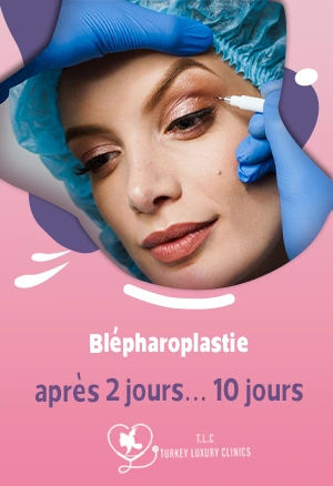 Blépharoplastie après 2 jours, 3 jours, 5 jours, 7 jours, 10 jours