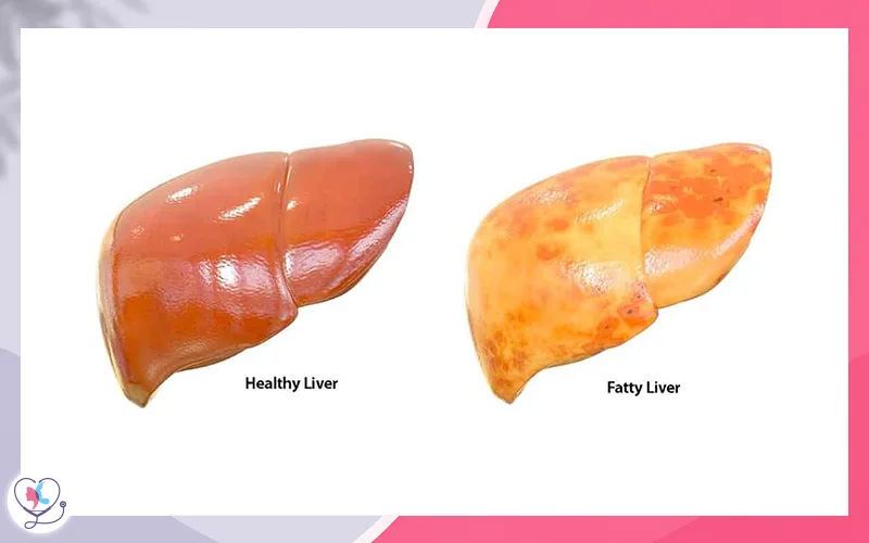 مرض الكبد الدهني المرتبط بخلل التمثيل الغذائي (METASLD أو سابقاً NAFLD)