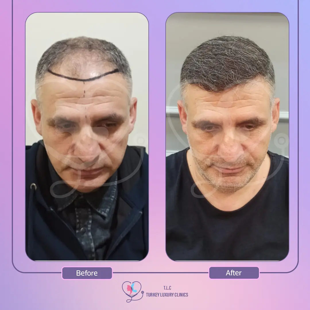 تكلفة زراعة الشعر في تركيا