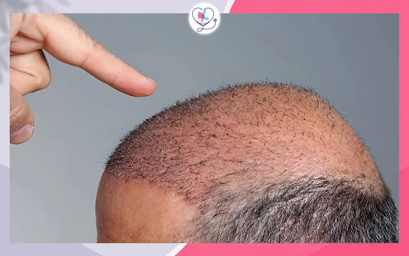 عدم نمو الشعر المزروع