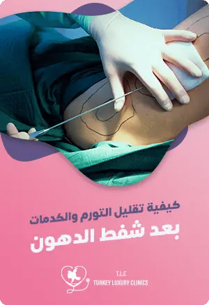 كيفية تقليل التورم والكدمات بعد شفط الدهون؟featured image