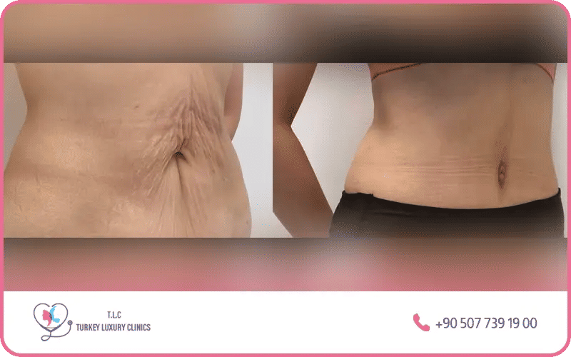 Les résultats montrent un ventre plat