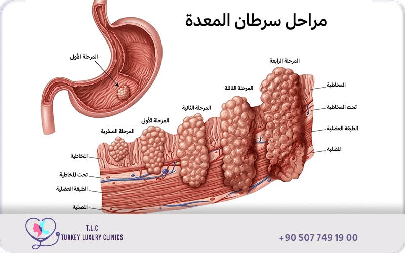 مراحل سرطان المعدة ونسب الشفاء