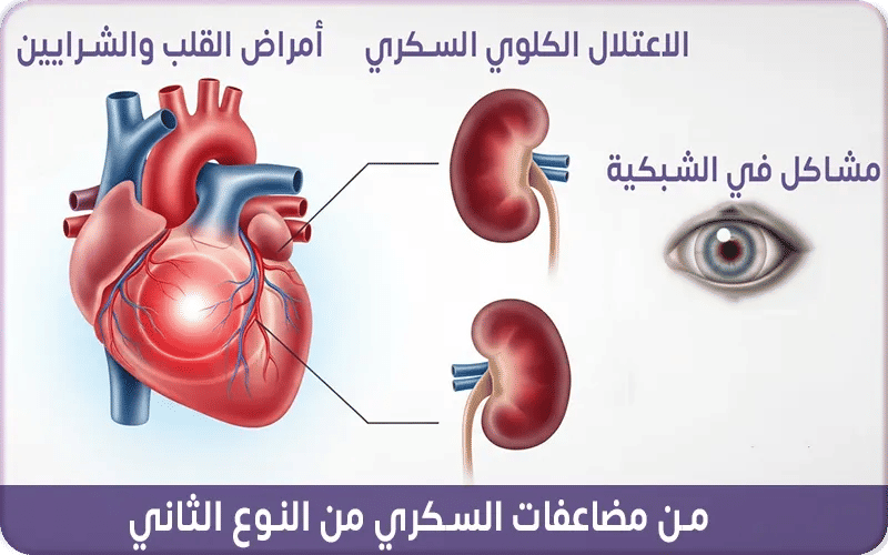 مضاعفات السكري من النوع الثاني