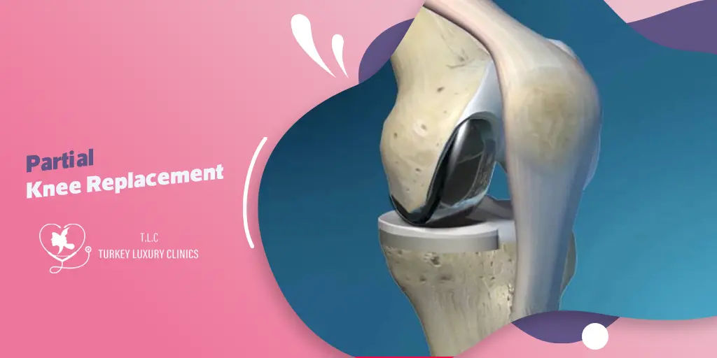 Partial Knee Replacement (PKR): The Full Guide