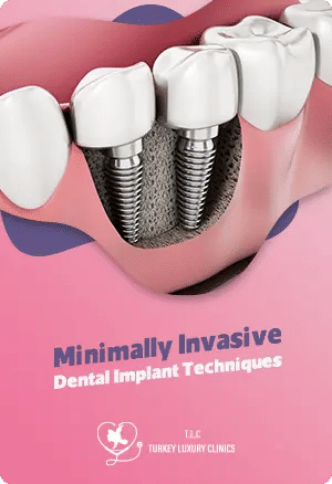Minimally Invasive Dental Implant Techniques: Faster Healing and Reduced Recovery Timefeatured image