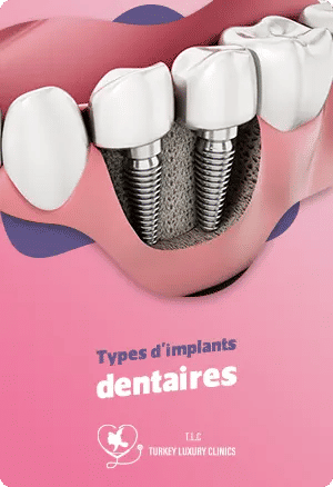 Types d'implants dentaires