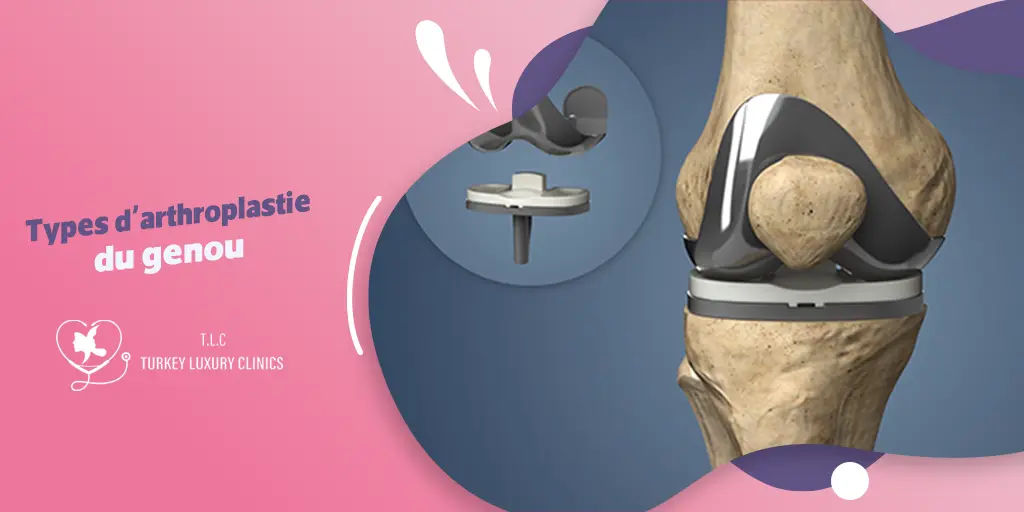 Types d'arthroplastie du genou