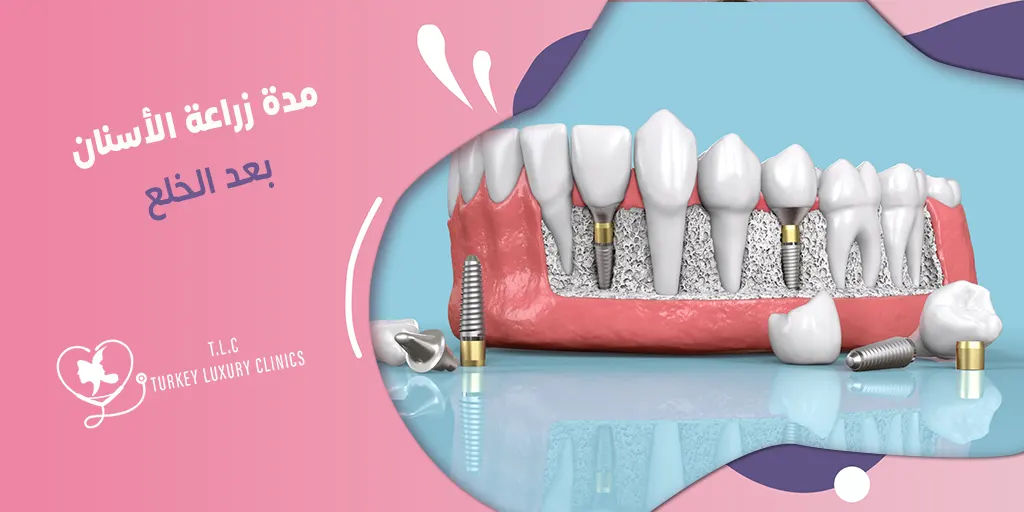 مدة زراعة الأسنان بعد الخلع: 1 ساعة وتزيد حسب الحالة