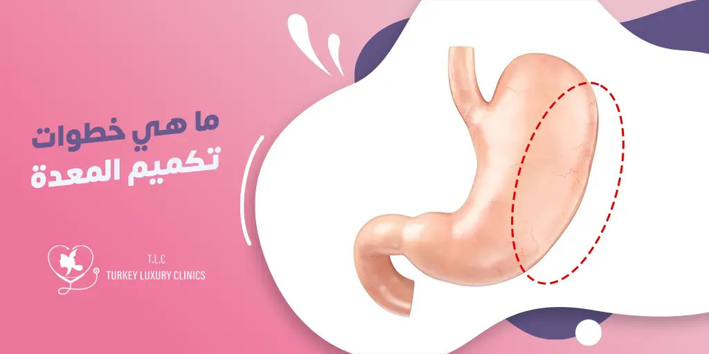 ما هي خطوات جراحة تكميم المعدة؟