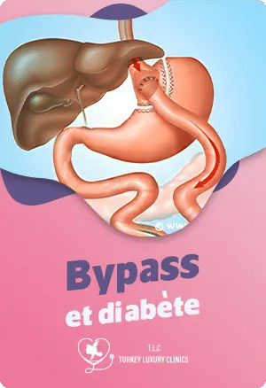 Bypass et diabète : Un traitement efficace pour le contrôle du diabètefeatured image