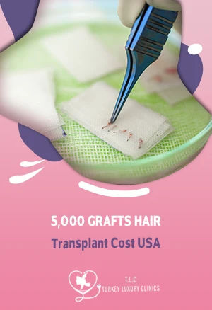 5,000 Grafts Hair Transplant Cost USA: Pricing with Turkey Comparison 2026