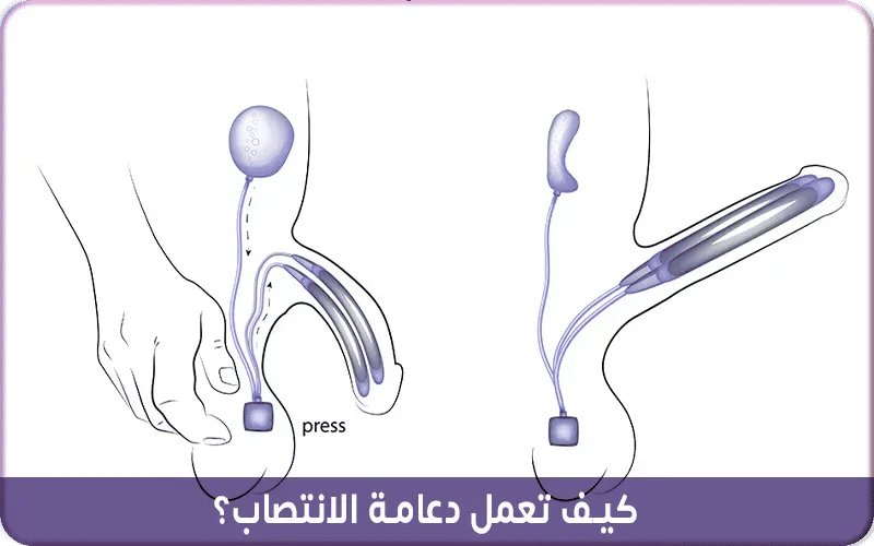 كيف تعمل دعامة الانتصاب؟