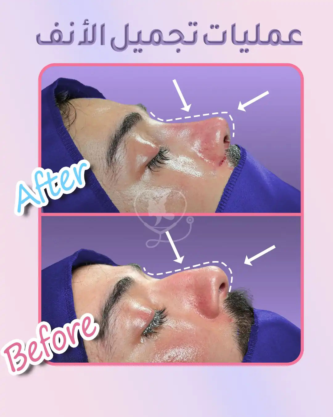 التخدير في عملية تجميل الأنف