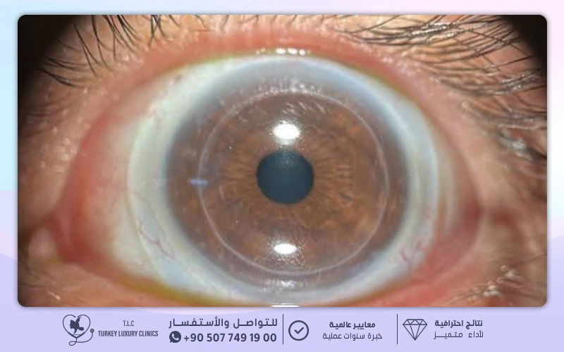 زراعة القرنية