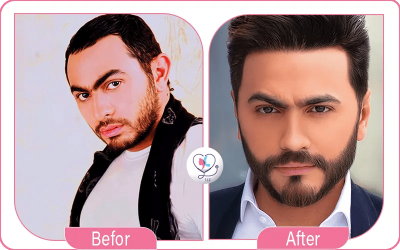 تامر حسني قبل و بعد زرع الشعر