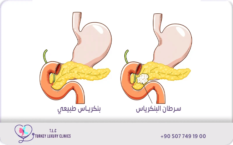 ما هو سرطان البنكرياس؟