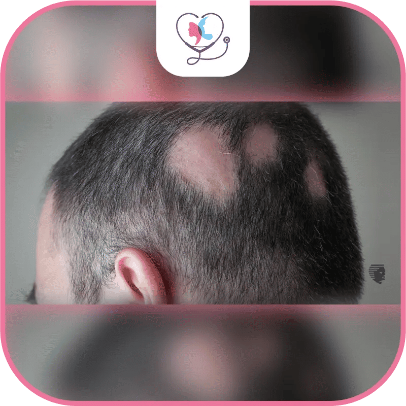 What is hair transplant for burns and scars?