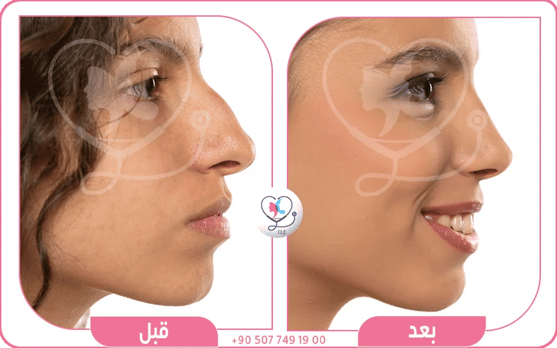 لماذا تختلف نتائج تجميل الأنف بين الأطباء