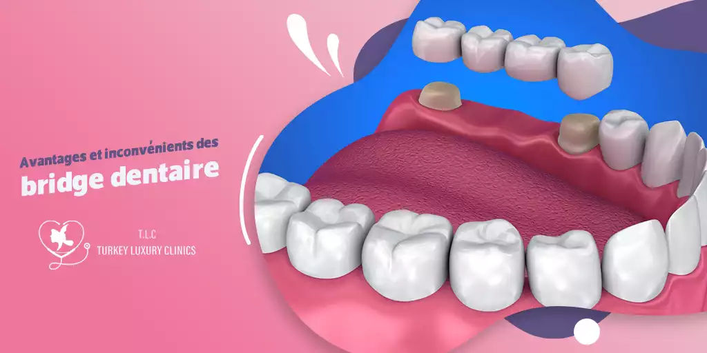 Avantages et inconvénients des bridges dentaires