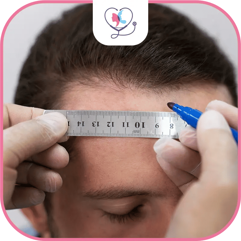 The Process Of Hair Transplant