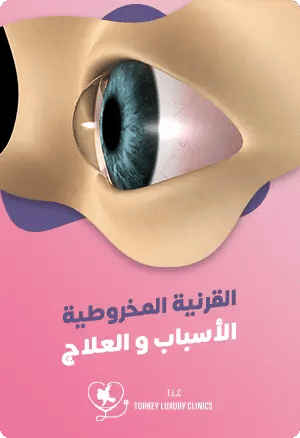 القرنية المخروطية: الأسباب، الأعراض والعلاجfeatured image