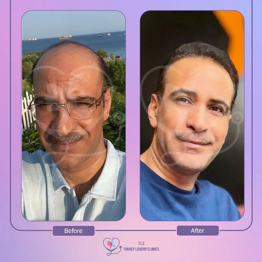 نتائج تجربتي مع زراعة الشعر قبل وبعد