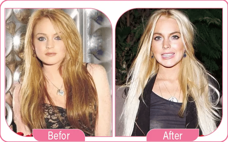 Lindsay Lohan Before and After Facelift