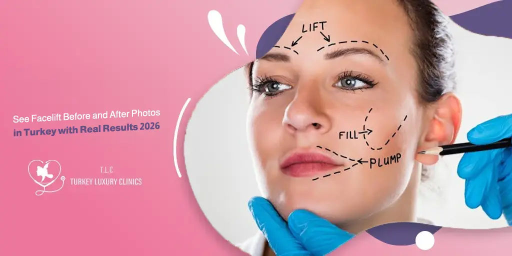 See Facelift Before and After Photos in Turkey with Real Results 2026