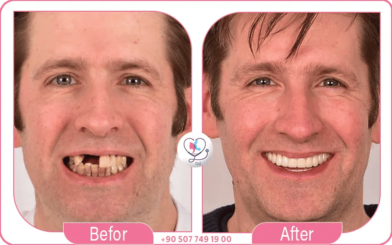 Pourquoi choisir turkey luxury clinic pour un implant dentaire