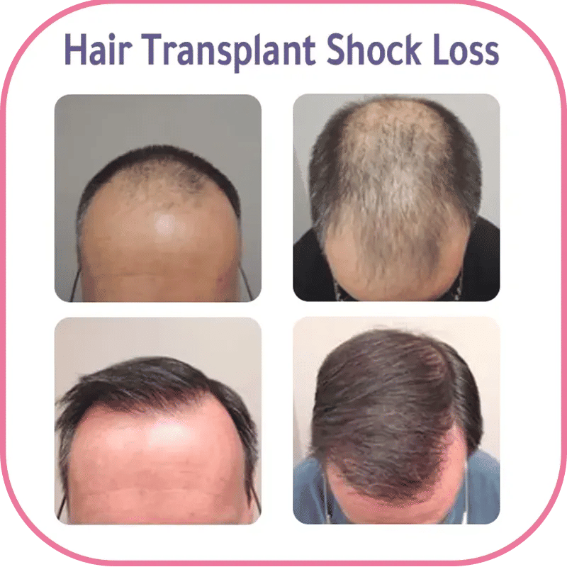 Hair Transplant Shock Loss Photos 2