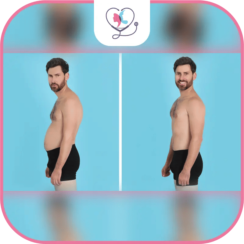  شفط دهون البطن